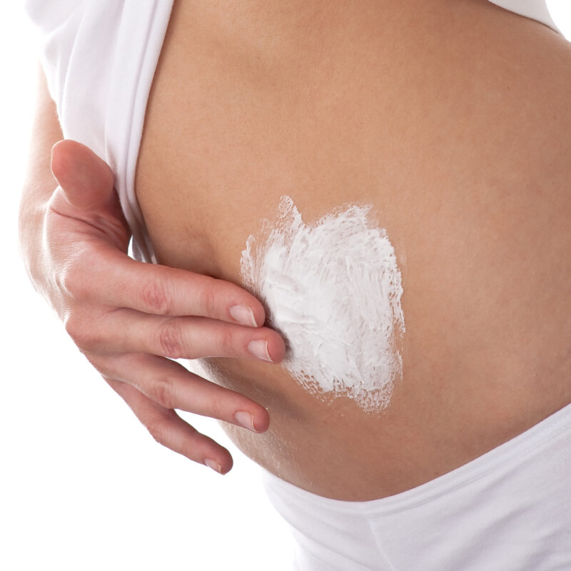 Woman applying cream on her stomach to illustrate what about weight loss surgery scars