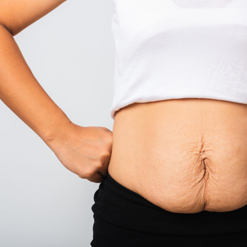 A woman with her white shirt pulled up to show loose belly skin to help illustrate How to Avoid Loose Skin After Weight Loss Surgery