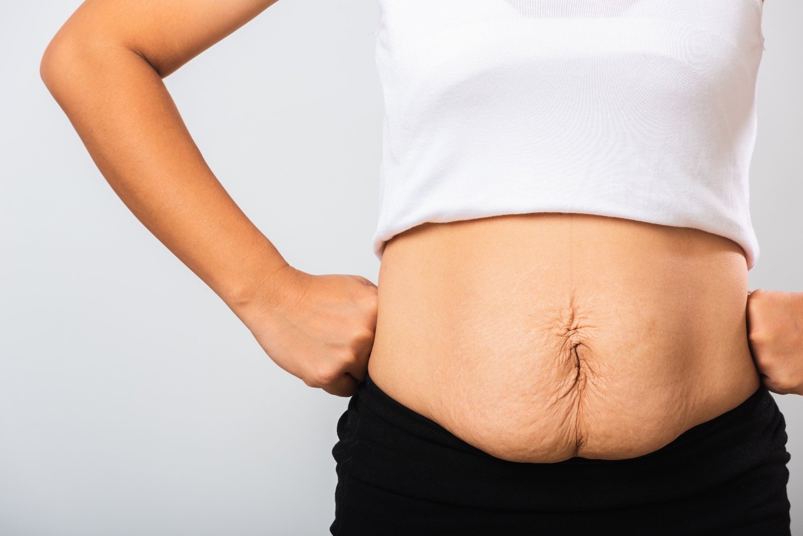 A woman with her white shirt pulled up to show loose belly skin to help illustrate How to Avoid Loose Skin After Weight Loss Surgery