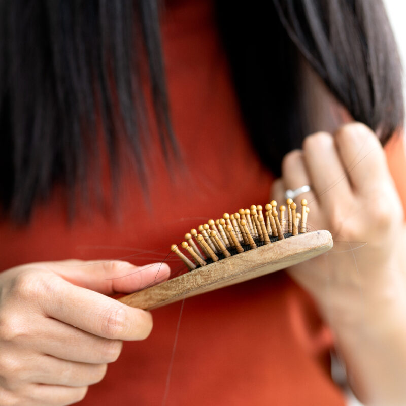 Woman looking at a hair brush to help illustrate Hair Loss After Weight Loss Surgery